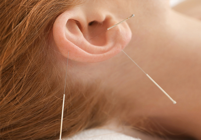 Auricular acupuncture